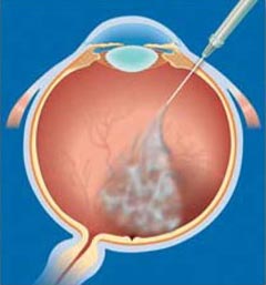 Grafik vom Berufsverband des Augenärzte BVA